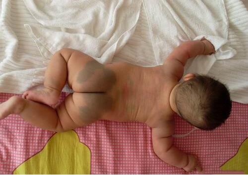 Lý giải sự thật đằng sau vết bớt xanh thường thấy trên mông trẻ sơ sinh - Ảnh 1