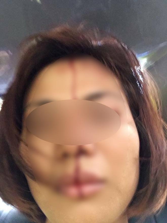 Hà Nội: Người phụ nữ trẻ 'tố' bị chồng cũ ép 'quan hệ', đánh đập dã man khiến nhập viện - Ảnh 1
