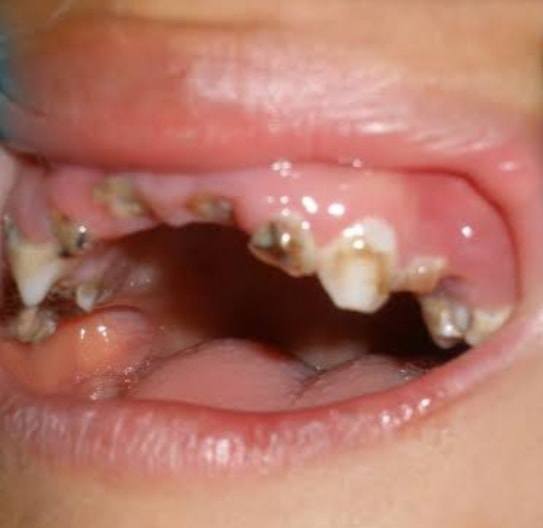 Con bị vi khuẩn ăn lên mắt, bố mẹ sốc khi biết nguyên nhân do ăn kẹo không đánh răng - Ảnh 3