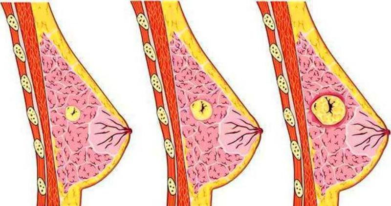Những loại bệnh tuyến vú lành tính mà nữ giới rất hay gặp phải, nên tìm hiểu ngay để chủ động chữa bệnh - Ảnh 2