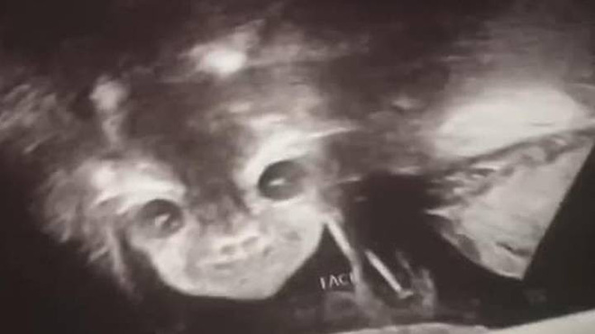 Đi siêu âm thai nhi 24 tuần tuổi, bà mẹ hết hồn khi thấy hình ảnh bé con như đang nhìn chằm chằm mình - Ảnh 1