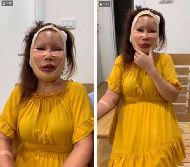 Cô dâu 63 tuổi ở Cao Bằng chính thức tháo băng sau 20 ngày phẫu thuật, khuôn mặt khiến ai nhìn cũng không thốt nên lời - Ảnh 1