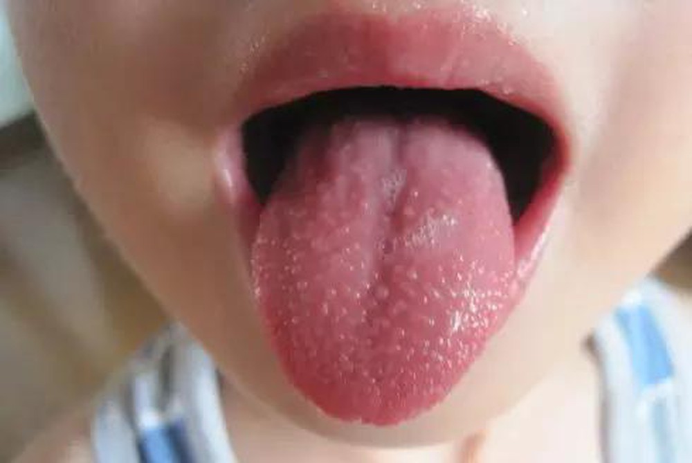Cha mẹ có biết: Đầu lưỡi trẻ có chấm đỏ là bệnh gì? - Ảnh 2