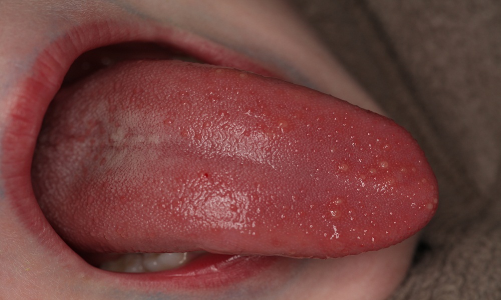 Cha mẹ có biết: Đầu lưỡi trẻ có chấm đỏ là bệnh gì? - Ảnh 5