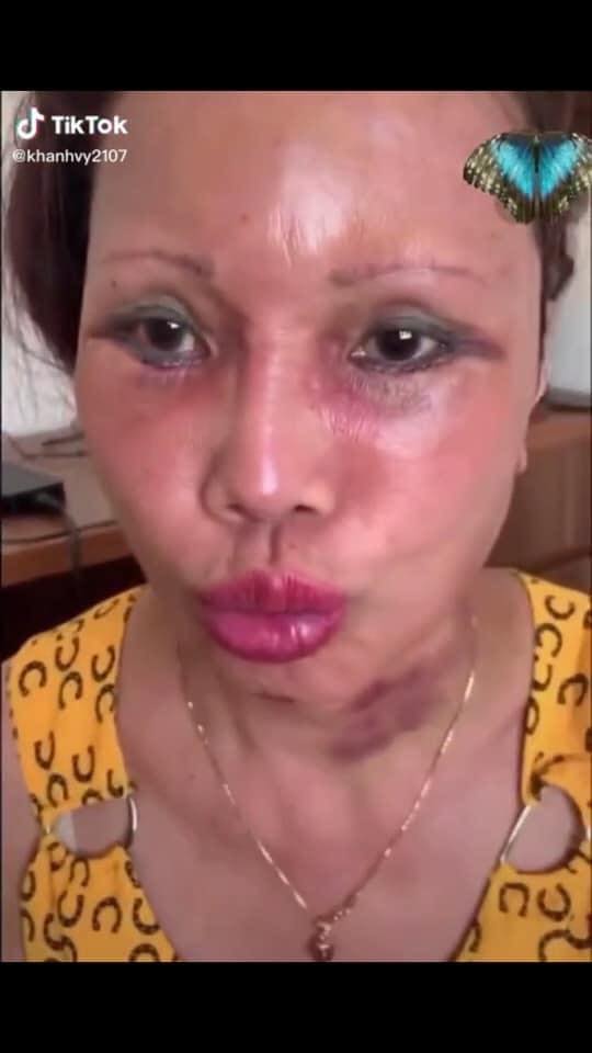 'Cô dâu 63 tuổi' ở Cao Bằng lại tiếp tục lộ diện khuôn mặt biến dạng, sưng phù không thể nhận ra - Ảnh 5