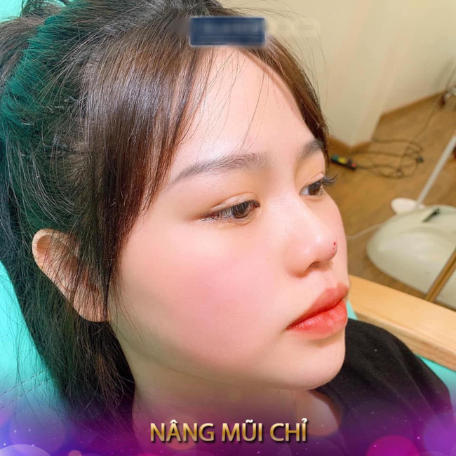 Vừa bị một spa lấy ảnh không xin phép để quảng cáo dịch vụ nâng mũi, hot girl Huỳnh Anh đăng ngay story chứng minh mình 'mũi tẹt' - Ảnh 1