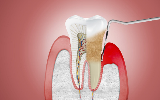 5 tác hại đáng sợ của việc lười đánh răng, không chăm sóc răng miệng đúng cách - Ảnh 2