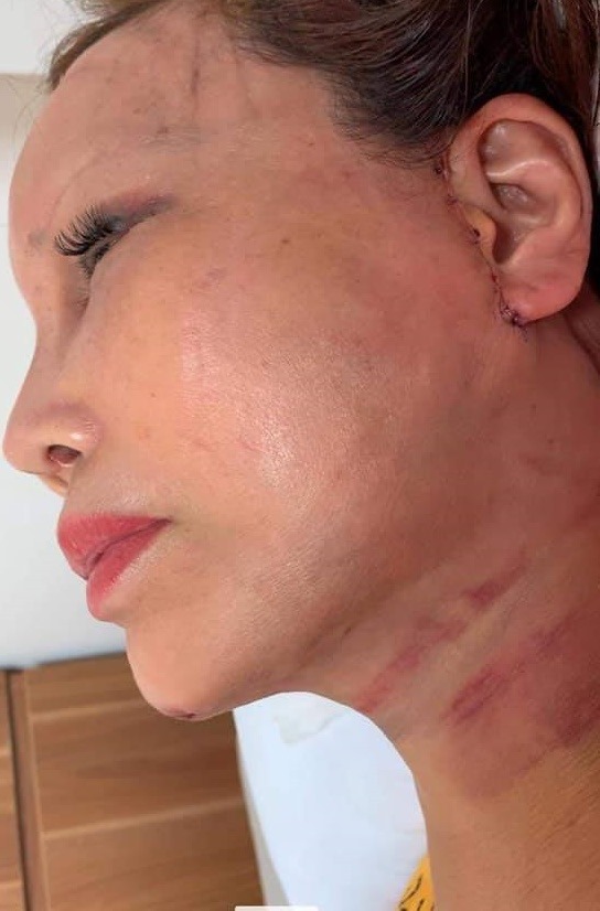 Cô dâu 63 tuổi ở Cao Bằng khoe vết sẹo chạy dọc phần tai sau 1 tháng phẫu thuật căng da mặt khiến nhiều người 'bủn rủn' - Ảnh 2