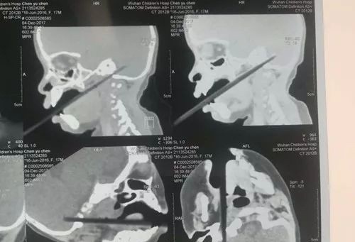 Tai nạn kinh khủng: Cha mẹ rời mắt trong thoáng chốc, bé 1 tuổi ngã khiến chiếc đũa trên tay xuyên qua vòm miệng chạm tới não - Ảnh 2