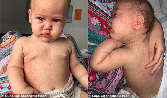 Con gái vật vã chiến đấu với bệnh sởi vì chưa được tiêm vắc xin, bà mẹ lên tiếng cảnh báo 'Sởi có thể giết người' - Ảnh 2