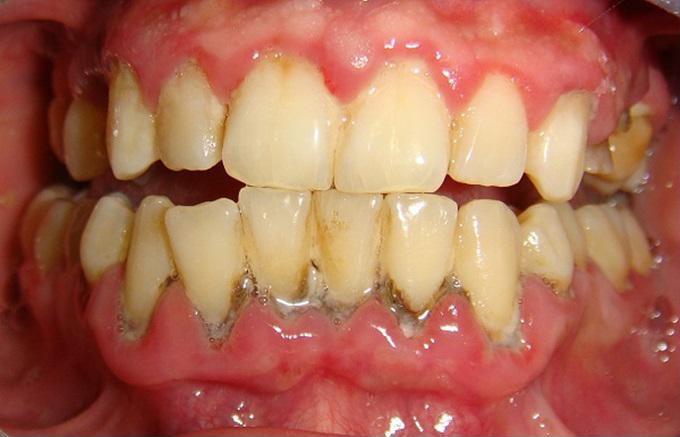 Nhai 3 viên lạc sống trong 5 phút, răng trắng như bọc sứ, cao răng cứng đầu sẽ tự bong ra, hiệu quả gấp 100 lần đến nha sĩ - Ảnh 1