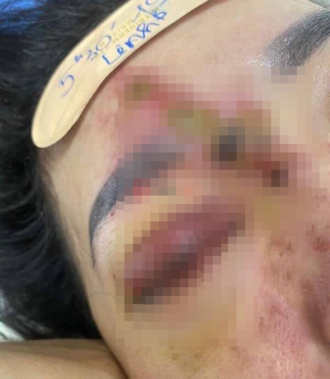 Đà Nẵng: Cô gái trẻ bị mù mắt phải sau khi tiêm filler nâng mũi ở spa - Ảnh 2