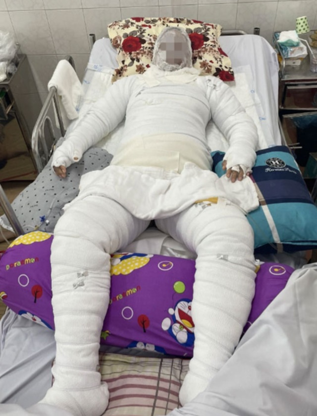Hi hữu: Thai phụ 37 tuần tuổi may mắn giữ được con khi bị bỏng nặng do gia đình nướng cồn ăn mực - Ảnh 1