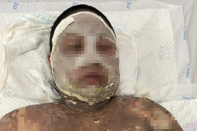 Hi hữu: Thai phụ 37 tuần tuổi may mắn giữ được con khi bị bỏng nặng do gia đình nướng cồn ăn mực - Ảnh 2