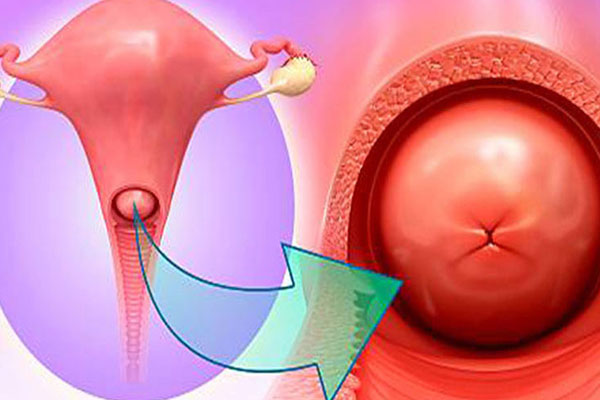 5 căn bệnh ở cổ tử cung tuyệt đối không được chủ quan kẻo ung thư, vô sinh gõ cửa - Ảnh 3
