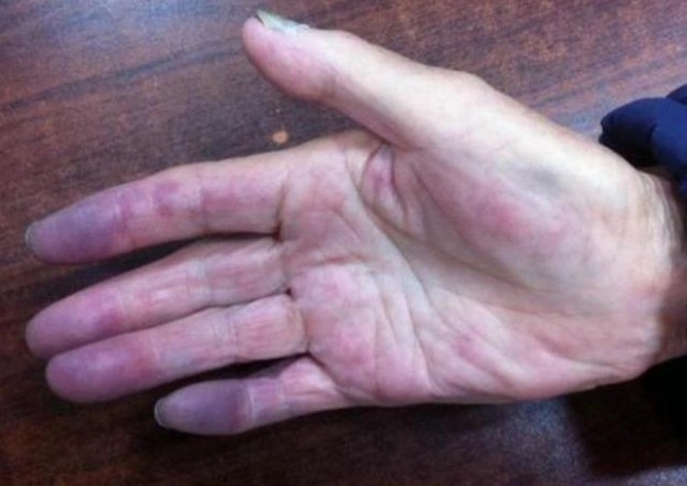 3 đặc điểm trên bàn tay chứng tỏ phổi bị tổn thương, ung thư đang ngấp nghé - Ảnh 1