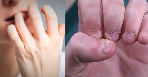5 hiểm họa khôn lường với sức khỏe từ thói quen cắn móng tay hàng ngày của nhiều người - Ảnh 1