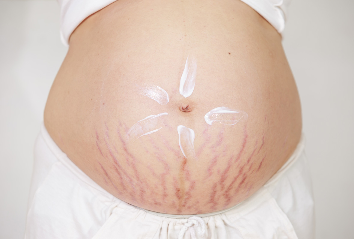 4 dấu hiệu sớm báo bạn chắc chắn sẽ bị rạn bụng khi mang thai - Ảnh 2
