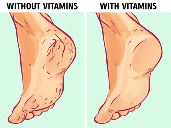 6 nguyên nhân làm gót chân bị nứt nẻ xấu xí và cách điều trị tại nhà hiệu quả - Ảnh 2