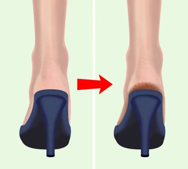 6 nguyên nhân làm gót chân bị nứt nẻ xấu xí và cách điều trị tại nhà hiệu quả - Ảnh 3