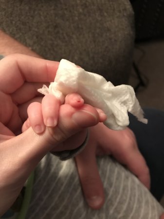 Xử lý khi Cắt móng tay cho trẻ sơ sinh bị chảy máu