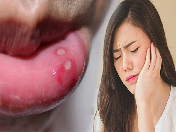 11 cách chữa nhiệt miệng hiệu quả ngay lập tức mà không cần dùng thuốc - Ảnh 1