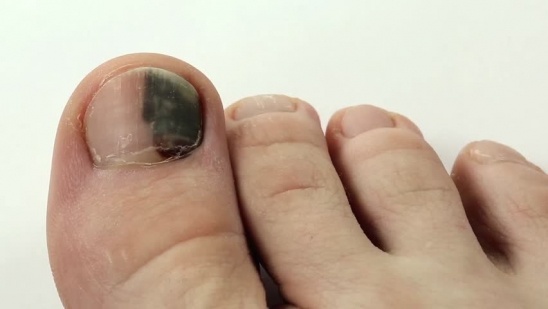 Dập móng khiến móng chân bị thâm đen kèm nhiều đau đớn
