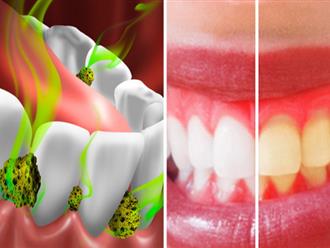 7 cách tiêu diệt vi khuẩn trong miệng và ngăn chặn hơi thở có mùi đơn giản nhất