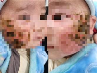 Tự đắp lá cây chữa viêm da, bé trai 4 tháng tuổi bị loét má nặng
