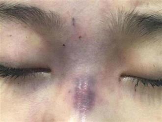 Bé gái 13 tuổi mù mắt vì tiêm filler nâng mũi