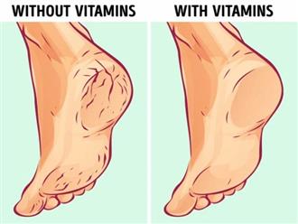 6 nguyên nhân làm gót chân bị nứt nẻ xấu xí và cách điều trị tại nhà hiệu quả