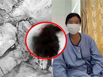 Đi tiểu ra lông - tóc, người phụ nữ U50 ở Hậu Giang tá hỏa phát hiện loại bệnh hiếm gặp, khám nhiều nơi mới tìm được nguyên do