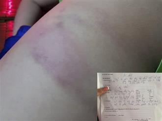 Bình Định: Cô giáo bị phụ huynh tố đánh học sinh lớp 3 bầm tím chân nhưng không xin lỗi