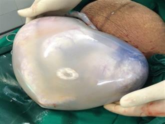 Chuyện hy hữu: Cặp song sinh nằm gọn trong bọc ối hình trái tim nguyên vẹn ở Hà Nội