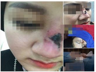 Bắc Giang: Kinh hoàng cô gái thủng sống mũi, lòi sụn vì tin lời 'bác sĩ phẫu thuật thẩm mỹ' 17 tuổi