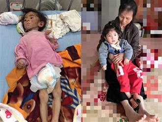 Hình ảnh mới nhất của bé gái Lào Cai bị suy dinh dưỡng: Cằm nhọn, cao lớn không nhận ra