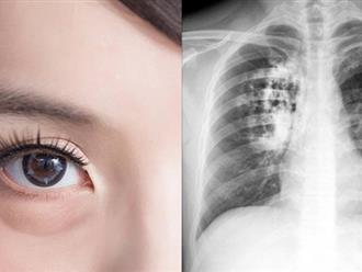 4 dấu hiệu bất thường ở đầu cảnh báo ung thư phổi, bạn có thể gặp triệu chứng này mà không hay biết  