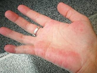 Xuất hiện dấu hiệu này trên bàn tay chứng tỏ bệnh gan đang rình rập, theo dõi kĩ để phòng tránh bệnh