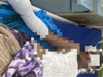Đắk Nông: Một học sinh bị nổ nát bàn tay, nghi do pháo tự chế