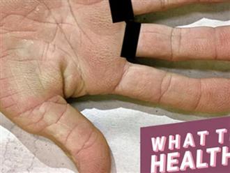 Cảnh báo: Nếu xuất hiện dấu hiệu này ở lòng bàn tay, rất có thể đã bị ung thư phổi!