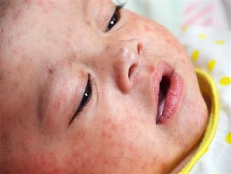 Cách phân biệt bệnh sởi và sốt phát ban thông thường