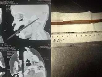 Tai nạn kinh khủng: Cha mẹ rời mắt trong thoáng chốc, bé 1 tuổi ngã khiến chiếc đũa trên tay xuyên qua vòm miệng chạm tới não