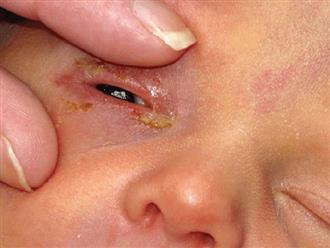 Trẻ sơ sinh bị đau mắt phải chữa trị tại nhà như thế nào?
