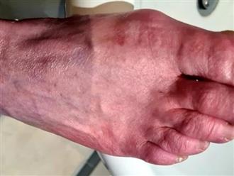 Hiện tượng ‘ngón chân COVID’: Ngón chân như bị bỏng phóng xạ, cơn đau như bị nổ tung từ bên trong