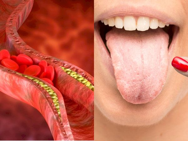 Triệu chứng cholesterol cao: Màu lưỡi này có thể báo hiệu mức cao đáng lo ngại - Ảnh 1