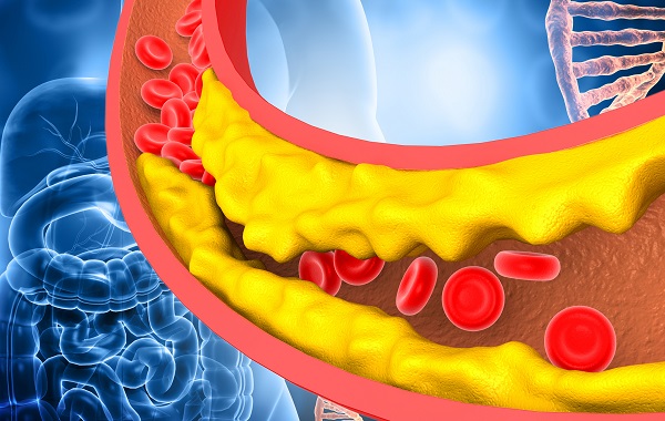 Triệu chứng cholesterol cao: Màu lưỡi này có thể báo hiệu mức cao đáng lo ngại - Ảnh 2