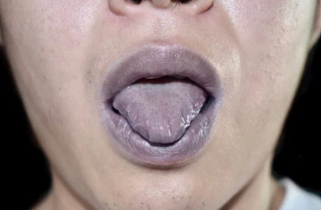 Triệu chứng cholesterol cao: Màu lưỡi này có thể báo hiệu mức cao đáng lo ngại - Ảnh 3