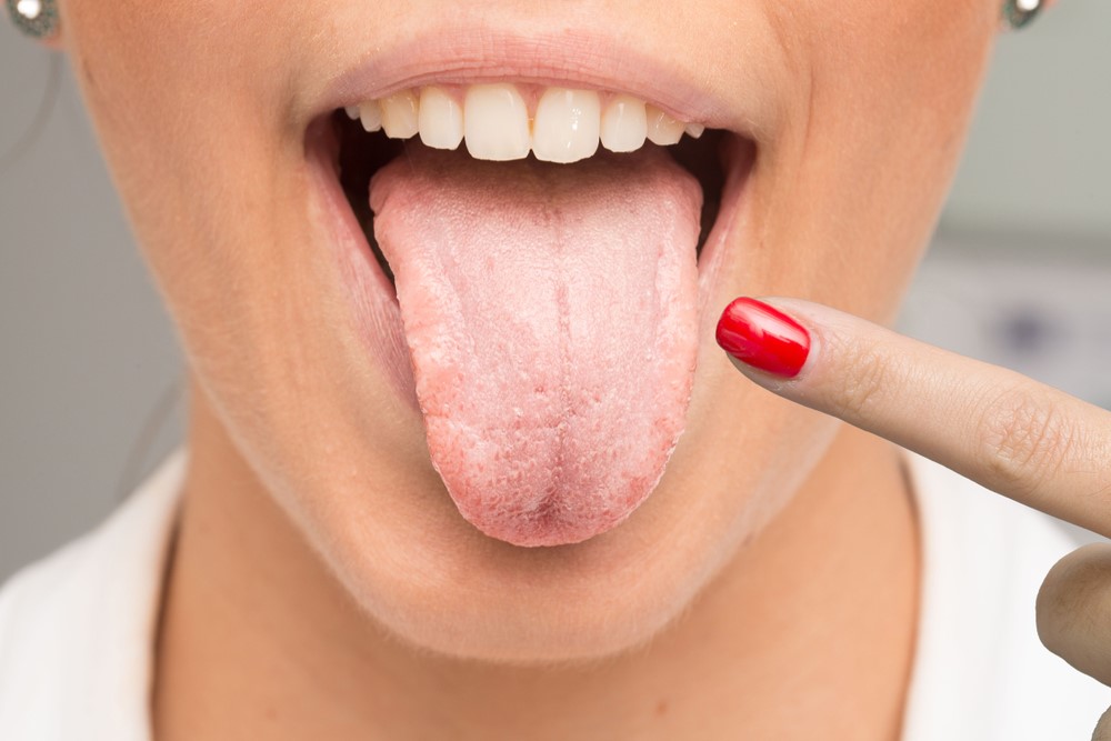 Triệu chứng cholesterol cao: Màu lưỡi này có thể báo hiệu mức cao đáng lo ngại - Ảnh 4